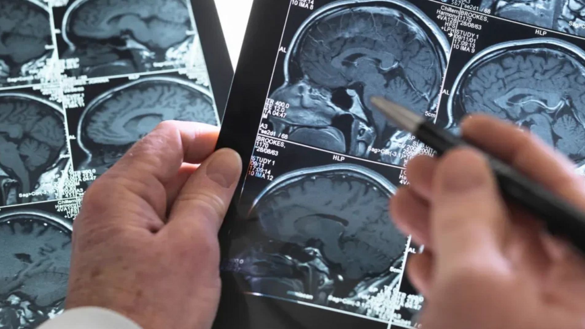 Día Mundial del ACV: las 5 señales de alerta que hay que reconocer a tiempo